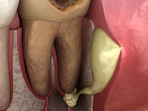 歯の根の膿の画像
