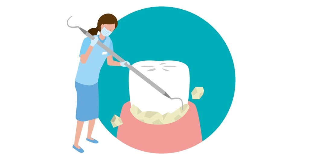 歯石を取り除く歯科衛生士の画像