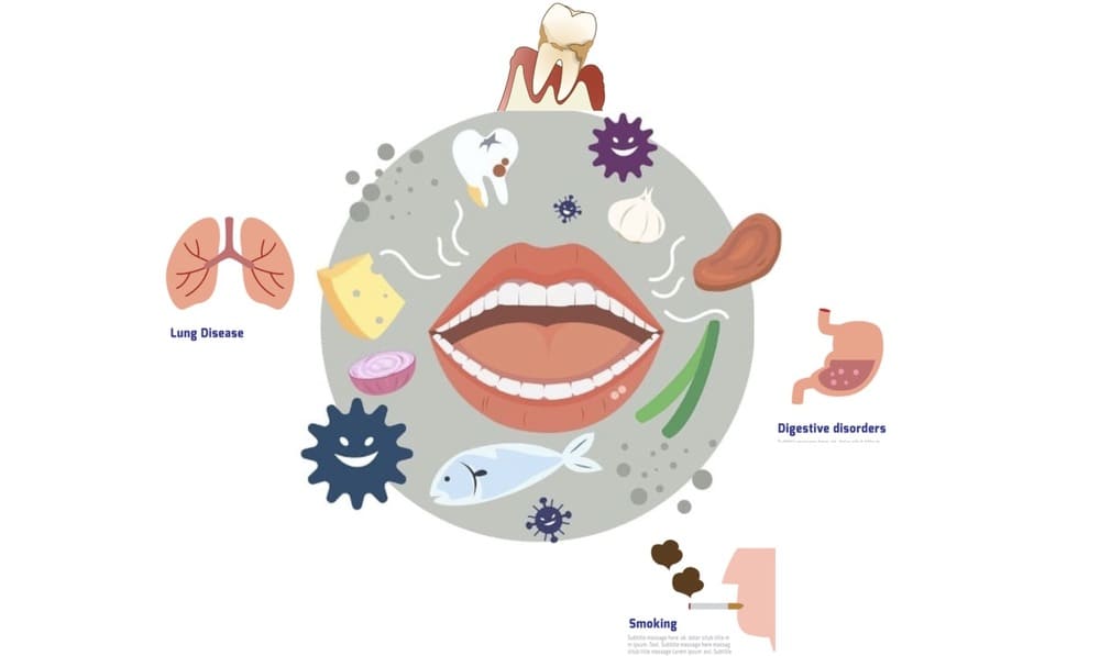 口臭の原因を示す画像