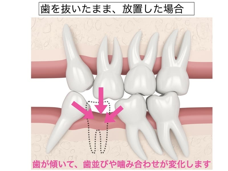 歯を失ったまま放置した場合の画像