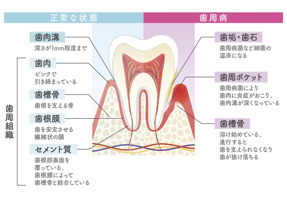 歯周病による歯茎と骨の炎症