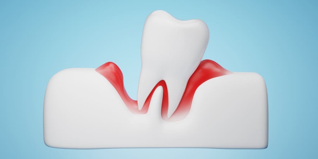 歯周病が原因で抜けそうな歯の画像