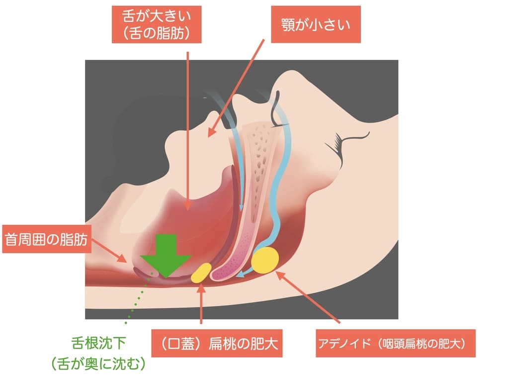 睡眠時無呼吸症候群の原因の解説画像