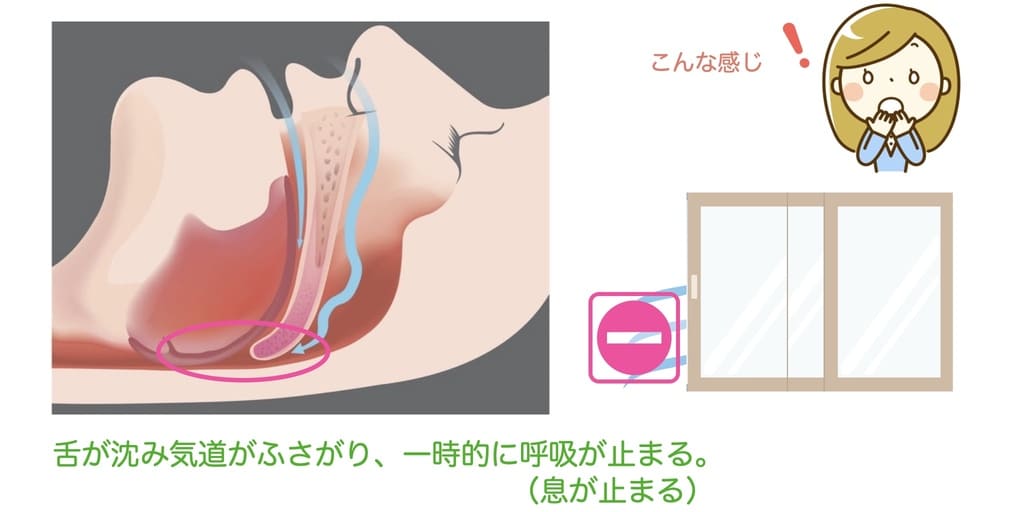 睡眠時無呼吸症候群の仕組みの解説画像