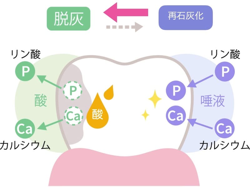 酸で歯が溶ける仕組みの画像