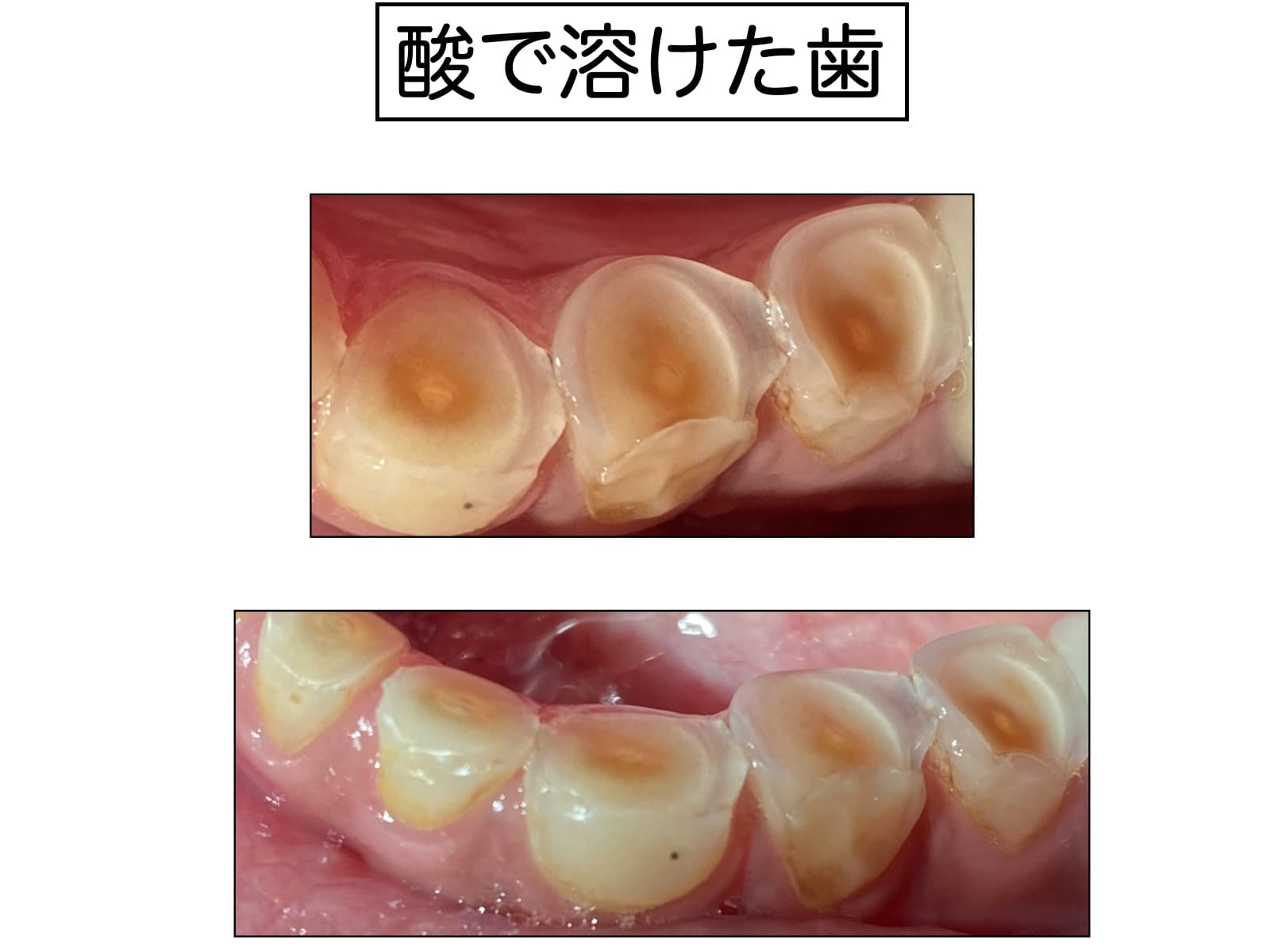 酸で溶けた歯の画像