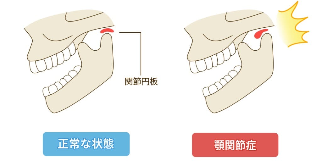 顎関節症を示す画像