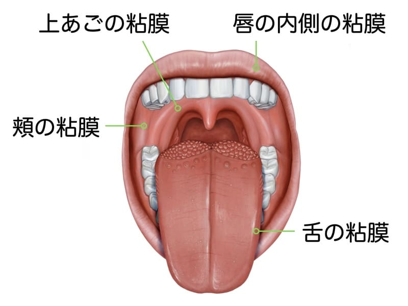 口内炎の好発部位の解説画像