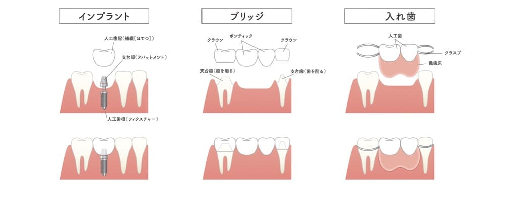 歯を抜いた後の治療方法の比較画像