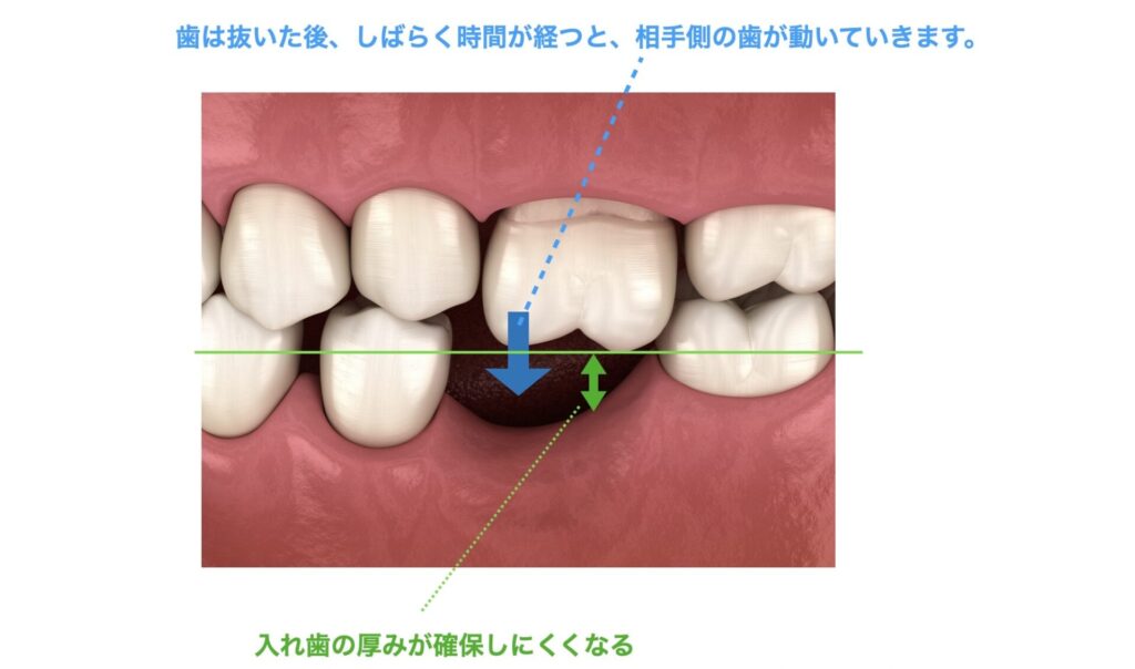 抜歯後に歯が動く