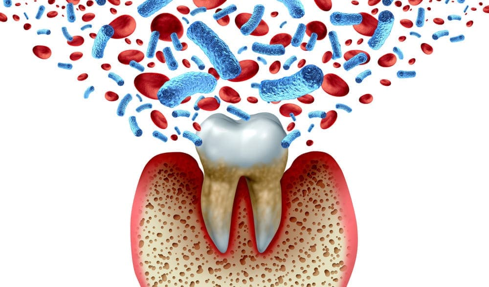 歯周病菌が全身へ与える影響の画像