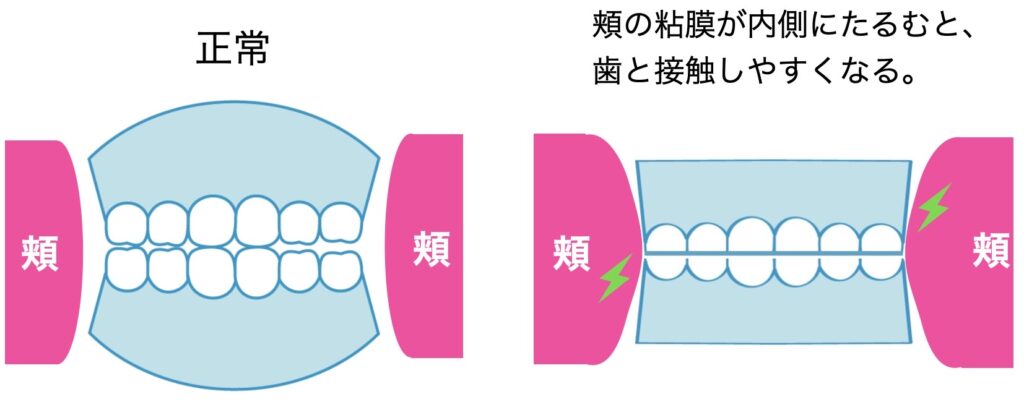 頬を噛んでしまう仕組み