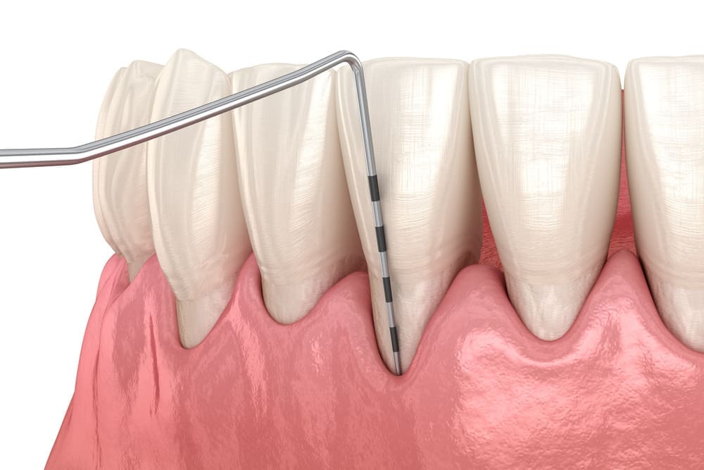 歯周病の検査（プロービング検査）