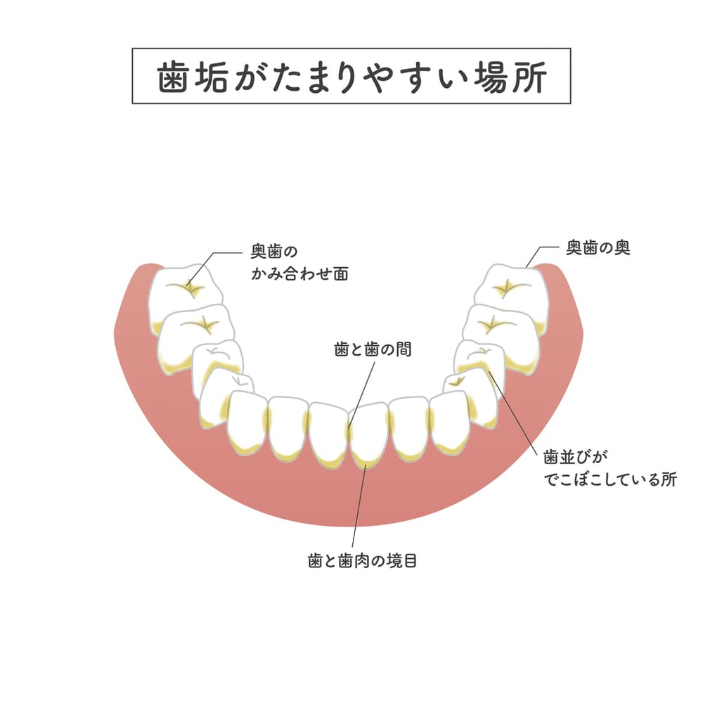 歯垢がつきやすい場所