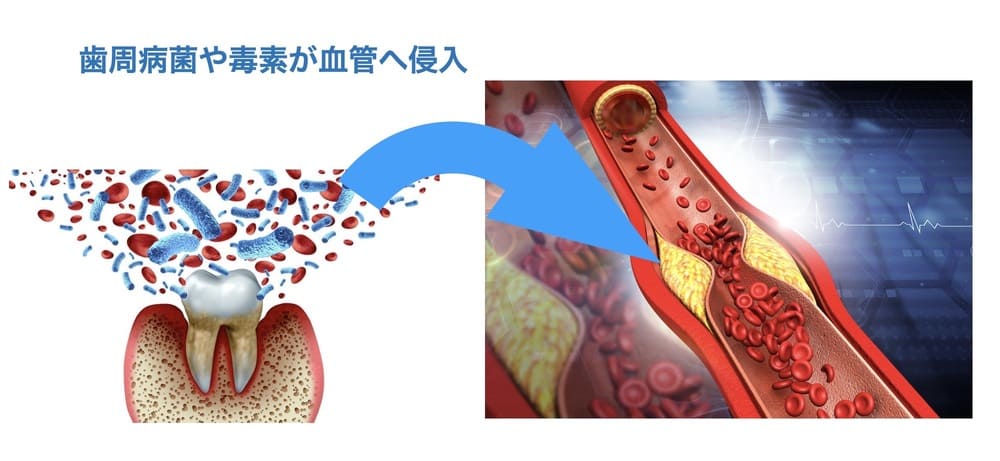 歯周病菌が引き起こす動脈硬化