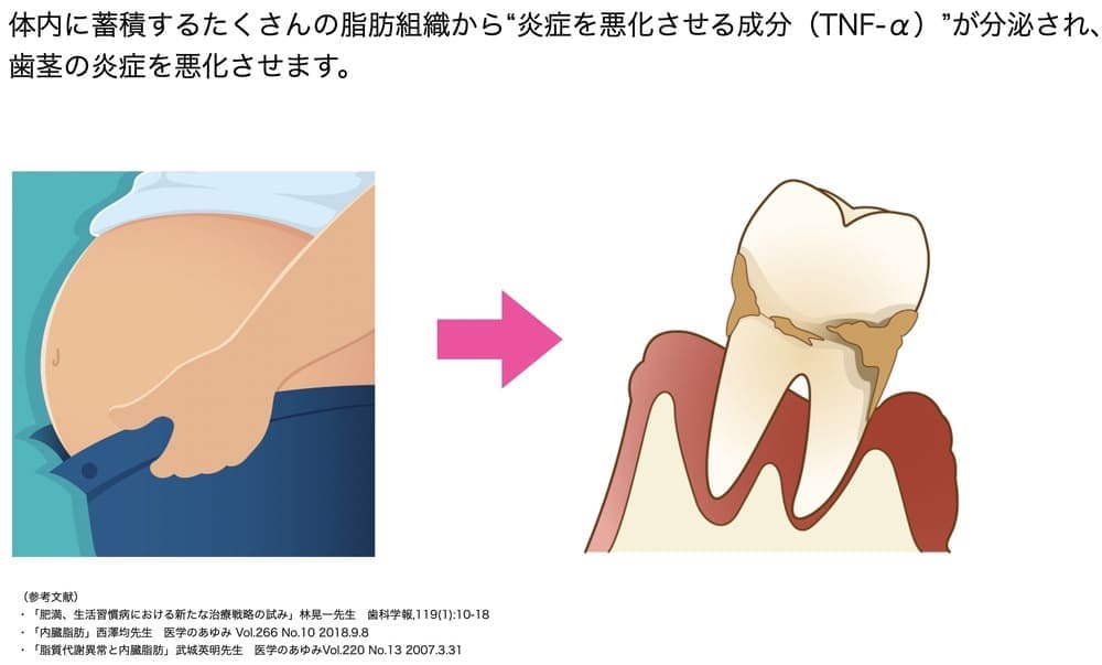 肥満が歯周病に与える影響