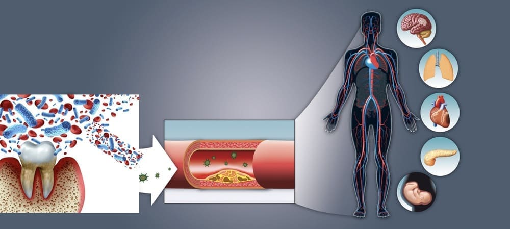 歯周病がもたらす全身の健康への影響