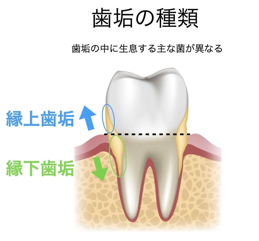 歯垢の種類を示す画像