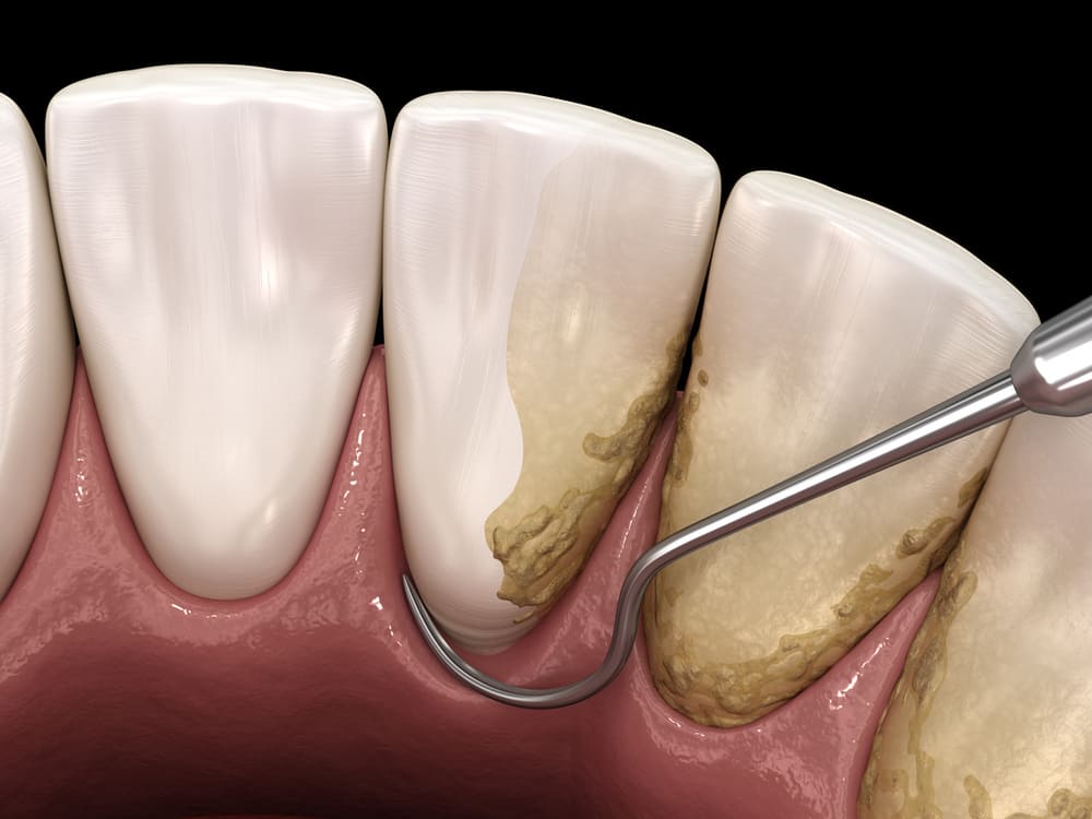 歯石取りの画像