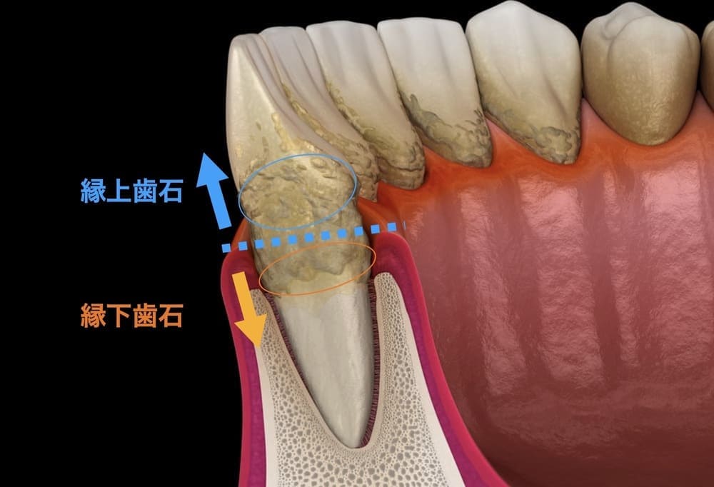 歯石の種類