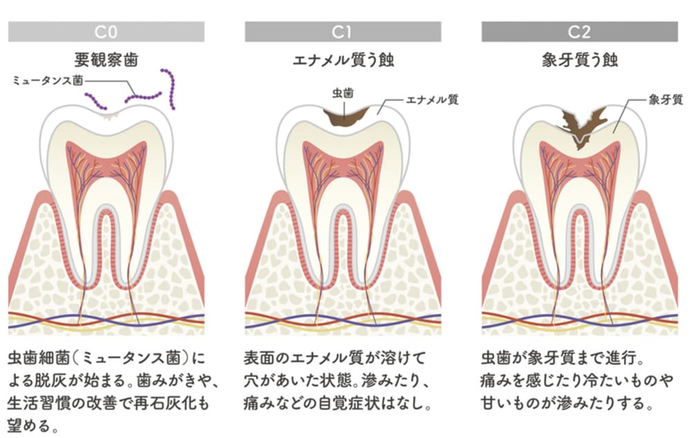 神経まで達していない虫歯