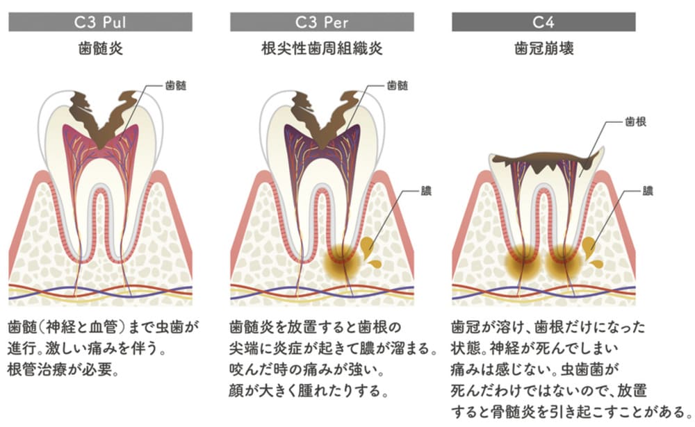 神経まで達する虫歯