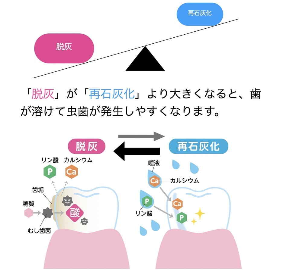 虫歯の発生の仕組み