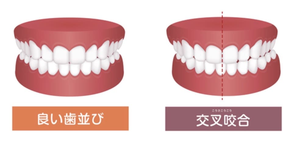 交叉咬合