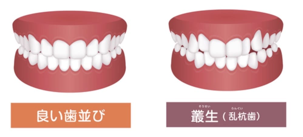 歯並びがガタガタ