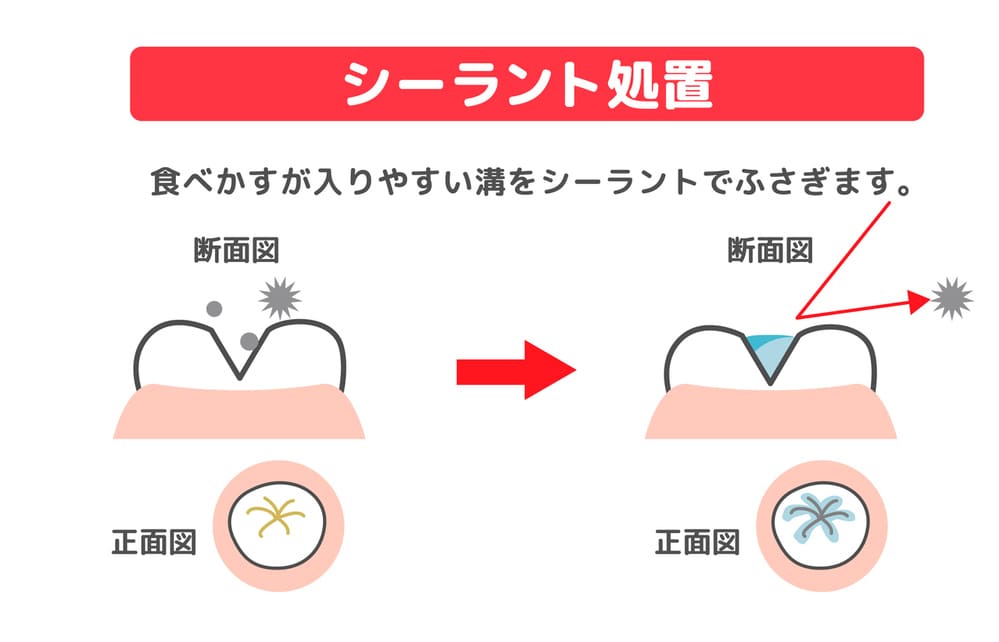 虫歯予防法のシーラント