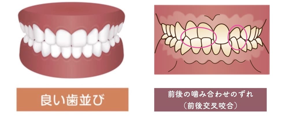 前後の噛み合わせのずれ