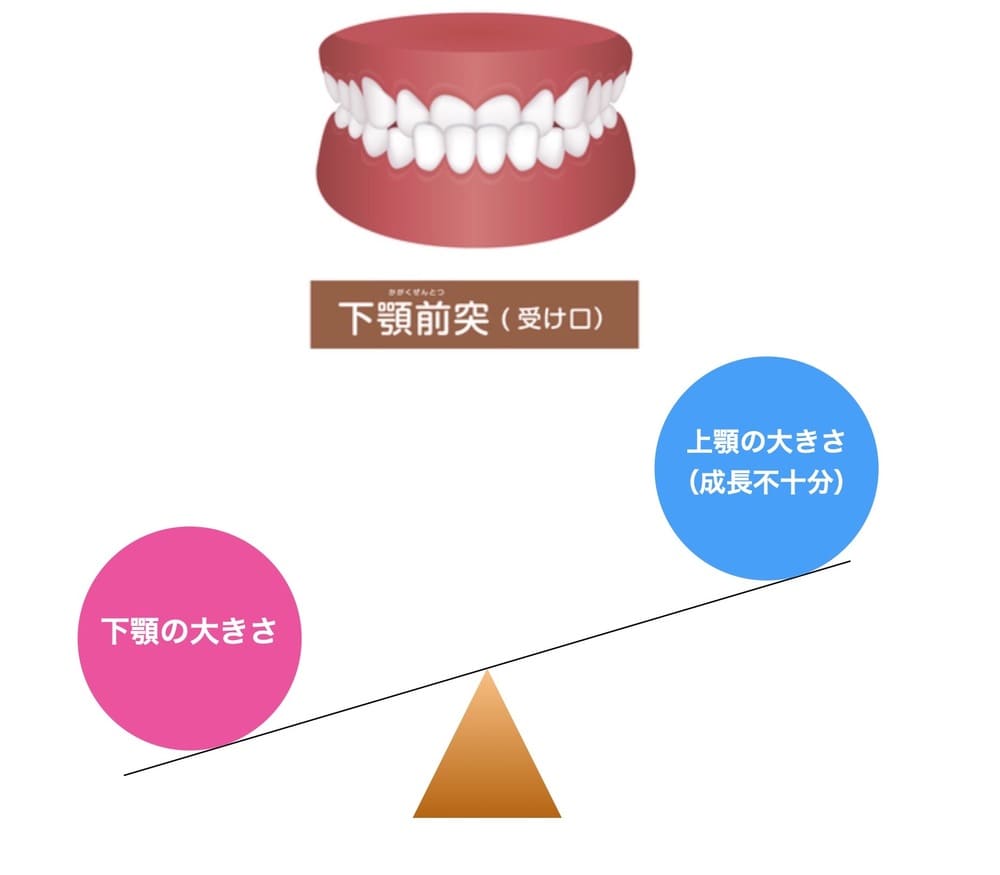 上顎の成長不足による受け口の画像