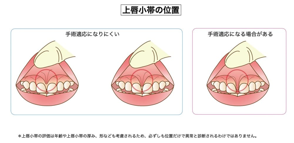 上唇小帯の異常のイラスト