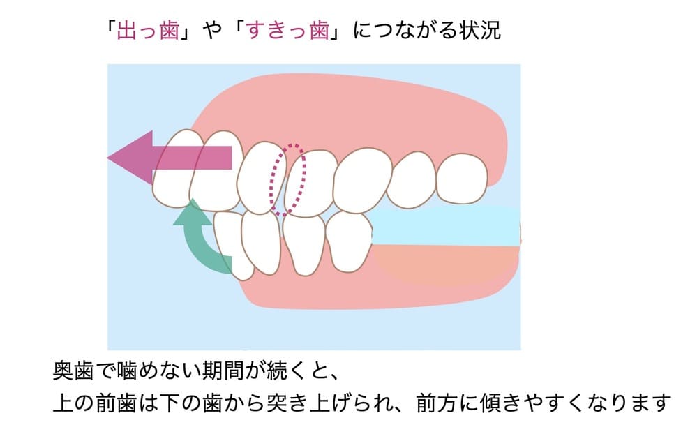 奥歯がないことによる弊害