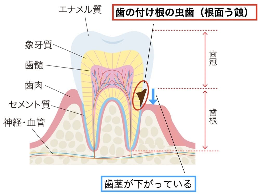 歯の付け根の虫歯の画像