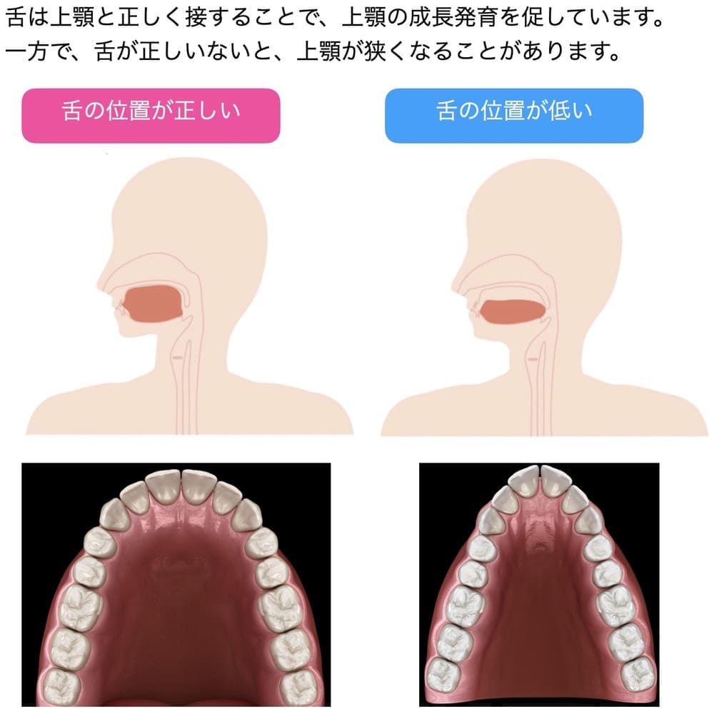 舌の位置を顎の成長の関係を示す画像