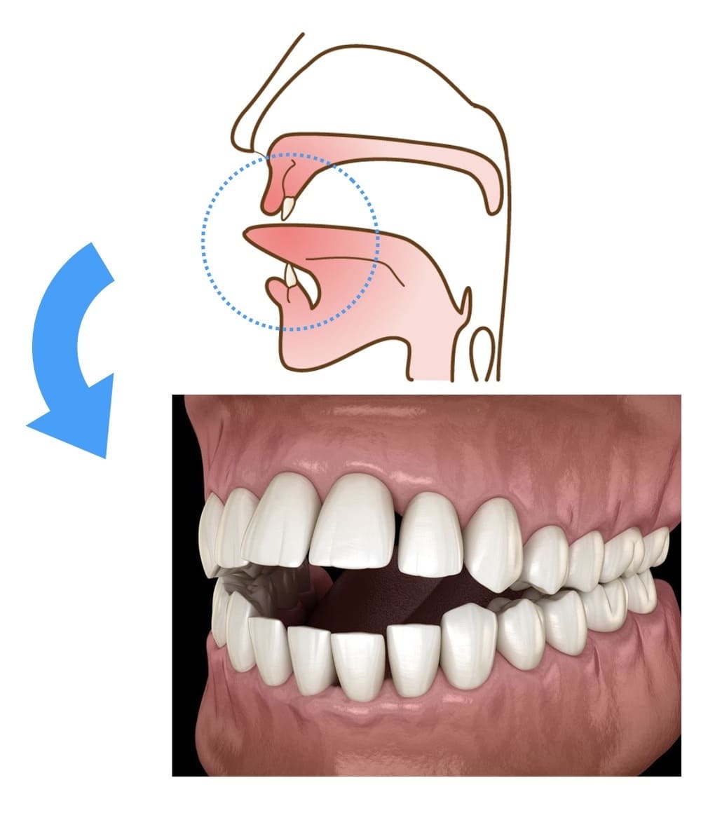 舌を前に出す癖によって前歯が噛めなくなった画像