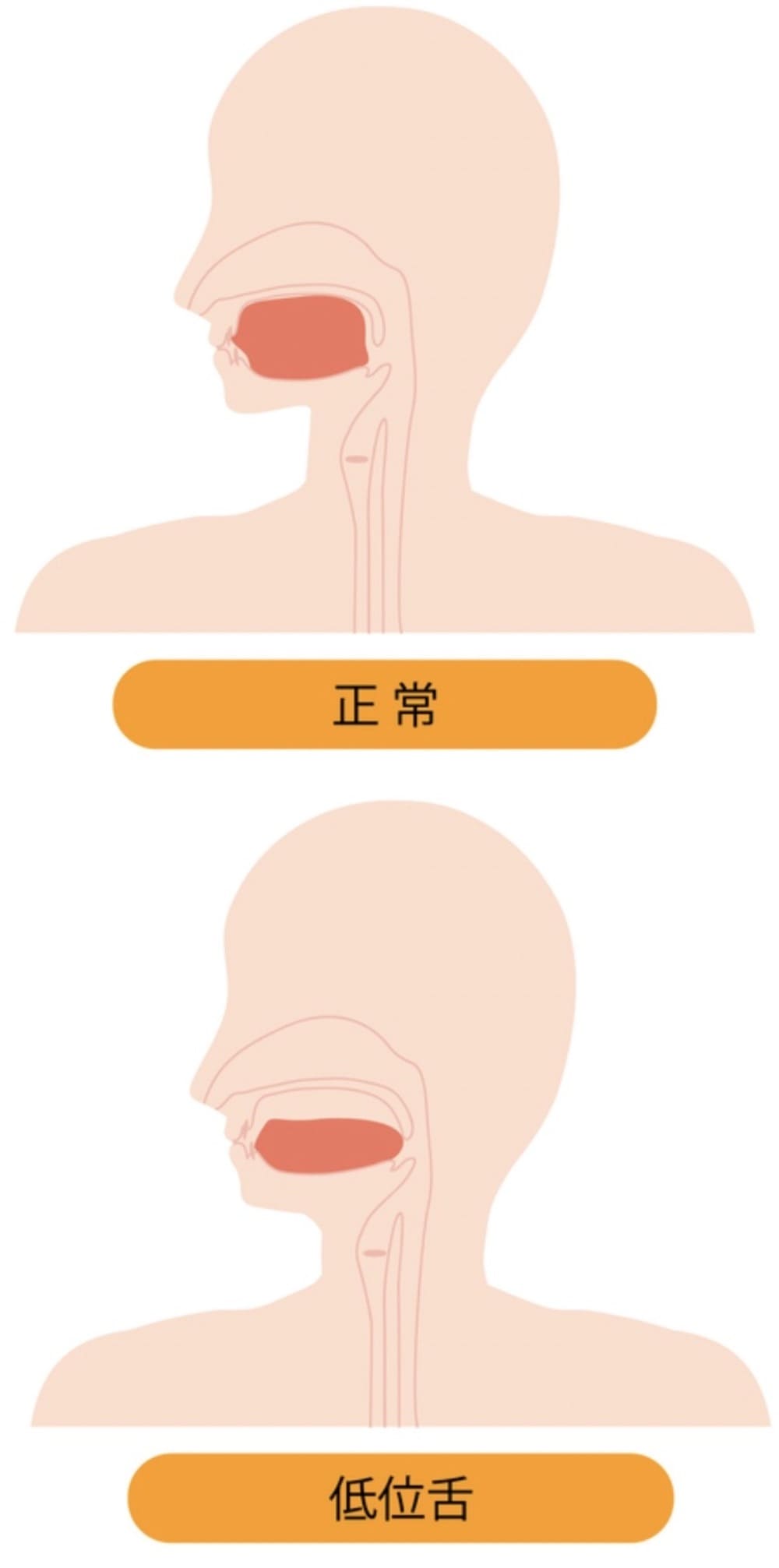 低位舌を示す画像