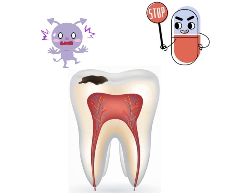 歯を削らない・神経を抜かない虫歯治療（3Mix療法）