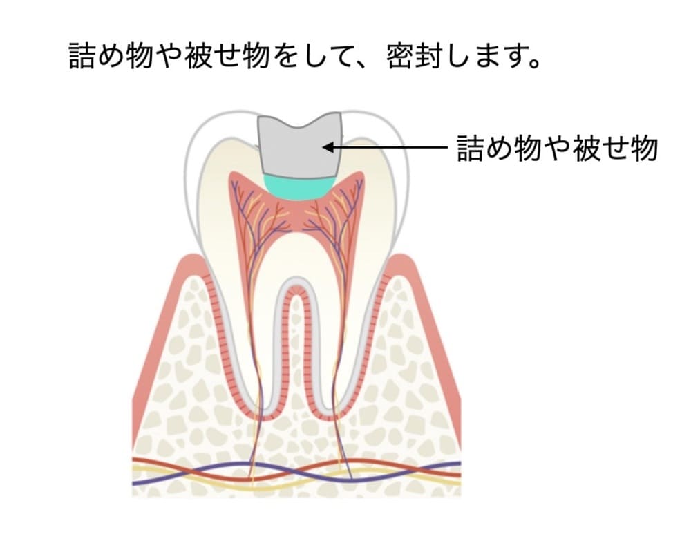 MTAセメントの上から詰め物をした画像