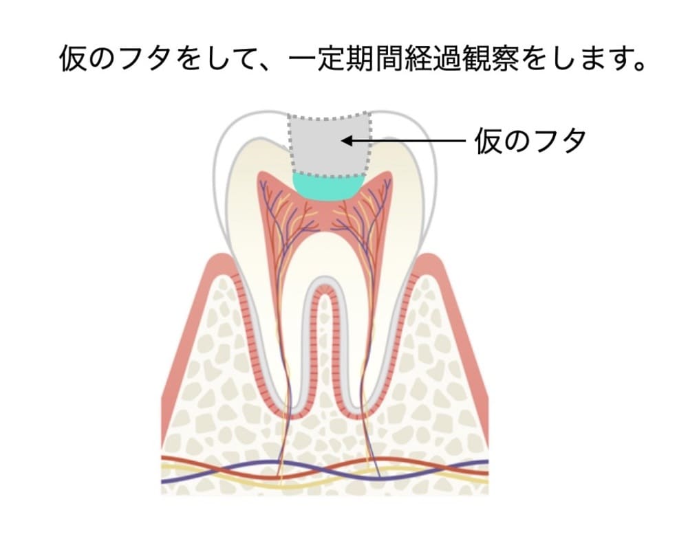 大きな虫歯の穴に仮封した画像