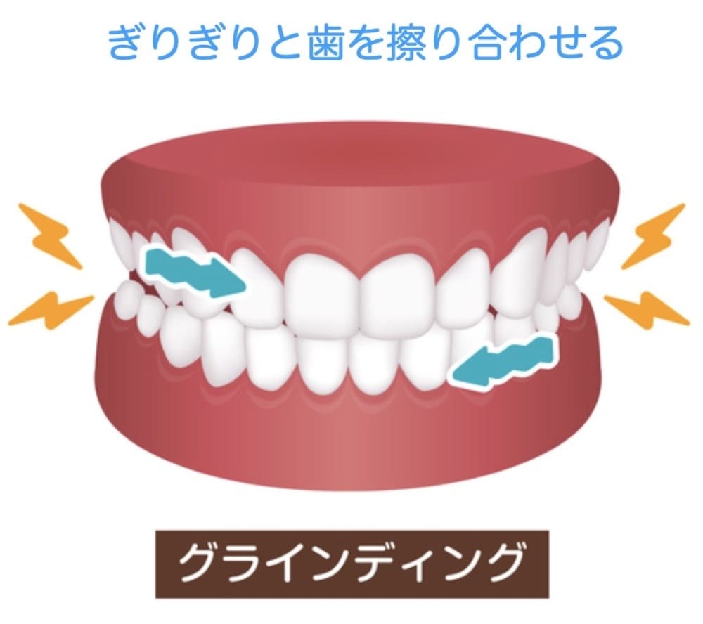 歯を擦り合わせる歯ぎしりのイラスト画像