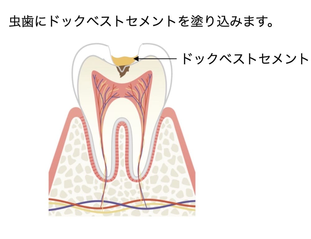 ドックベストセメント治療の説明画像2