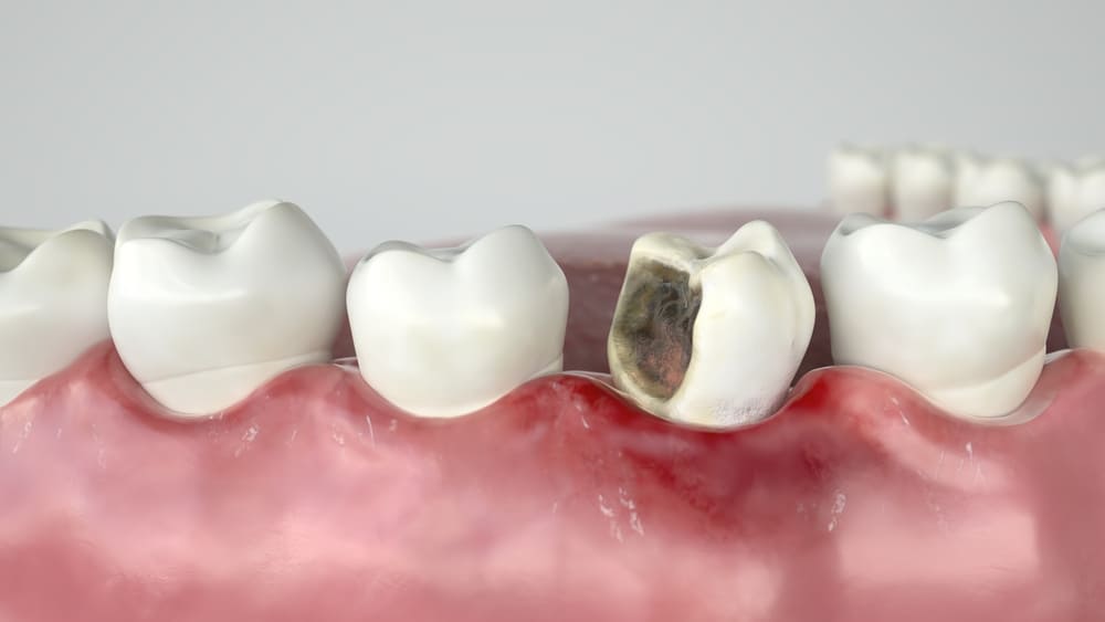 虫歯が原因で欠けた歯の画像