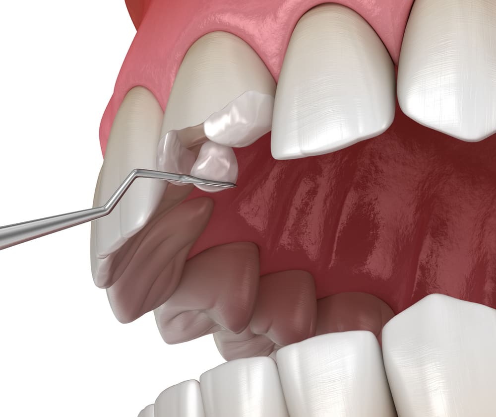 欠けた歯の修復治療の画像