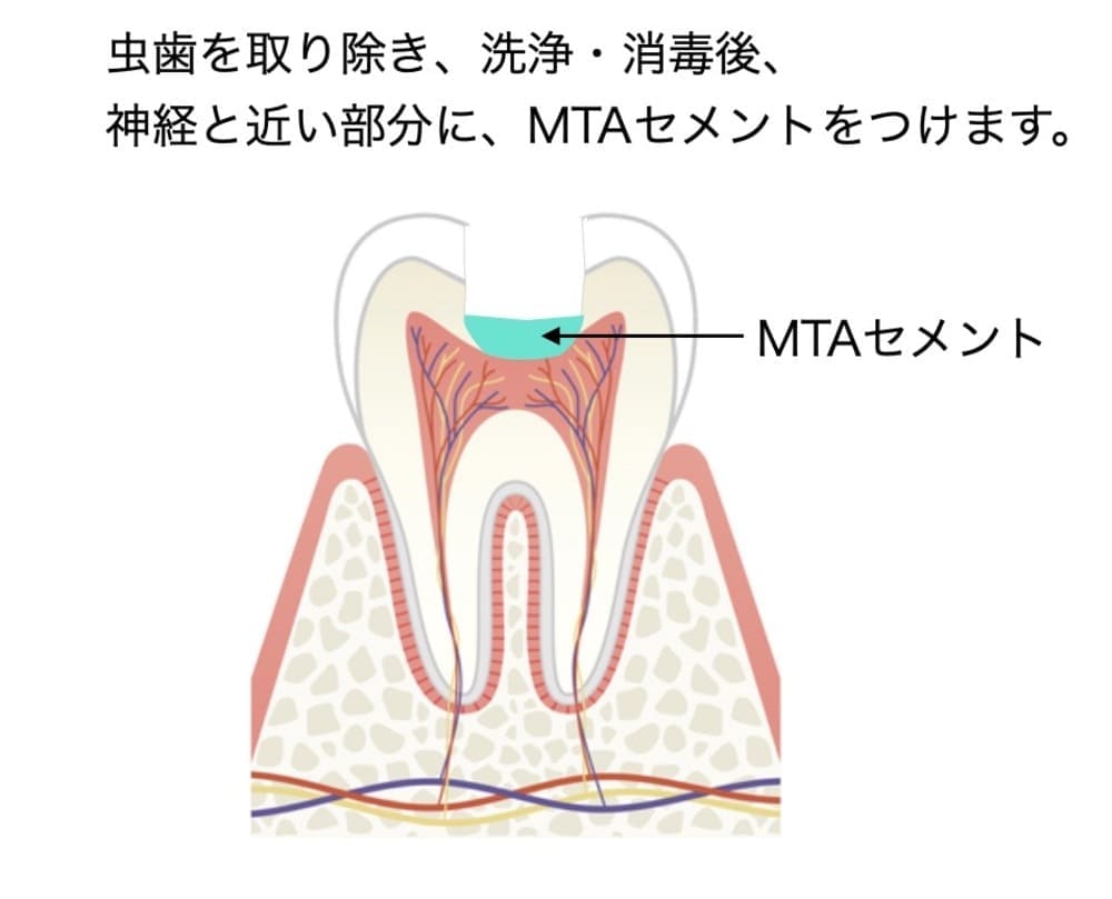 深い虫歯を取り除き、MTAセメントを塗布した画像