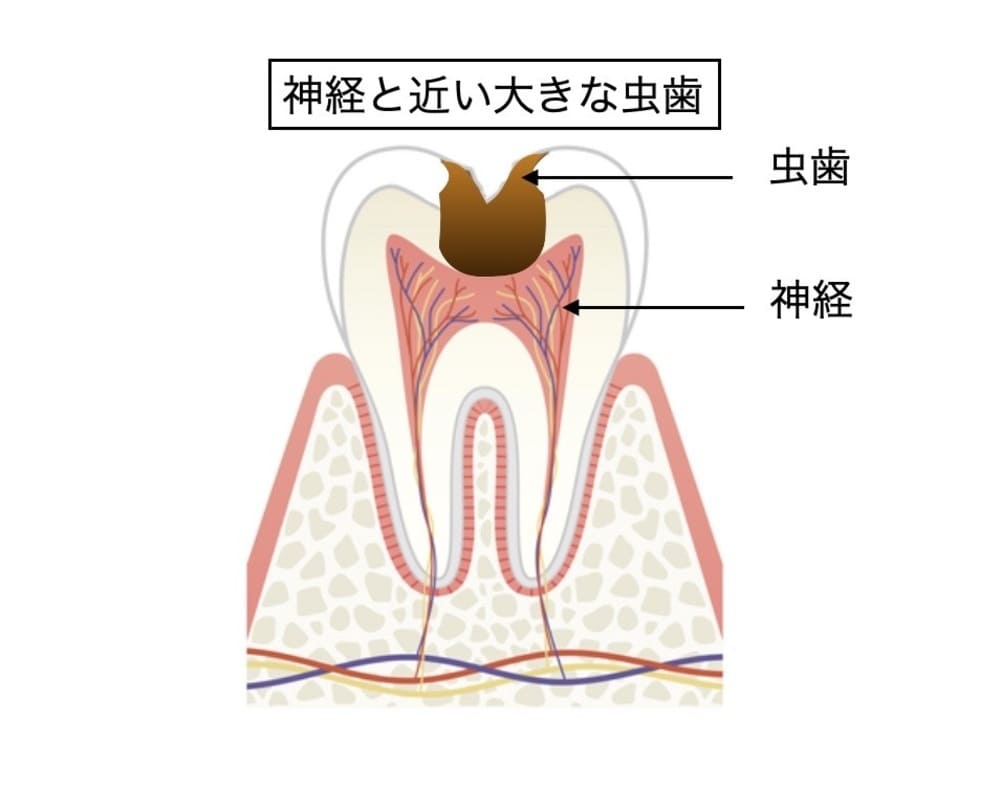 神経と近い、大きな虫歯のイラスト画像