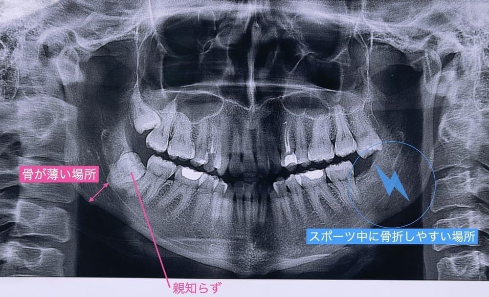 親知らずの存在と顎骨骨折を示す画像