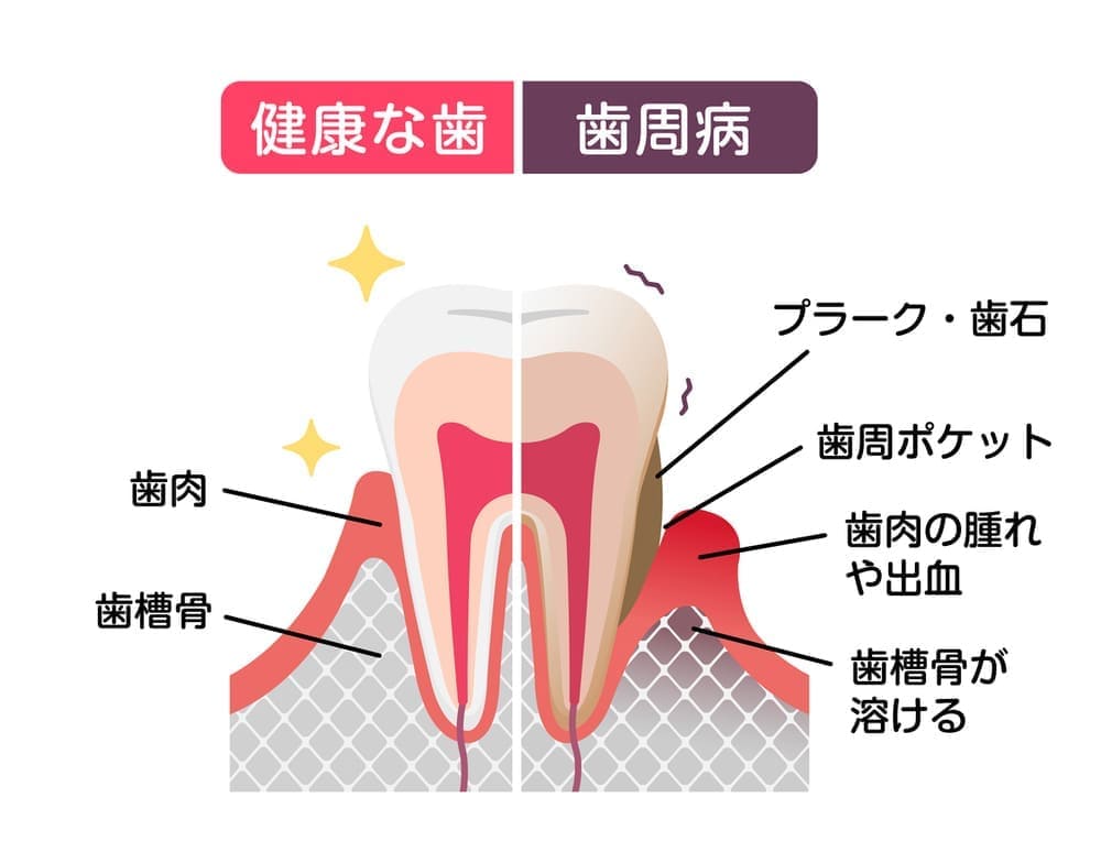 歯周病と健康な歯茎の比較画像