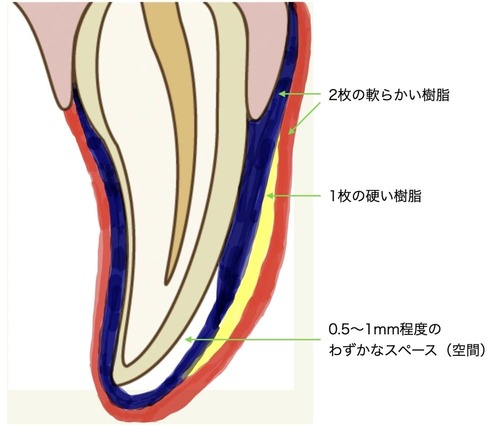 スポーツ用マウスガード（3層構造）の仕組み